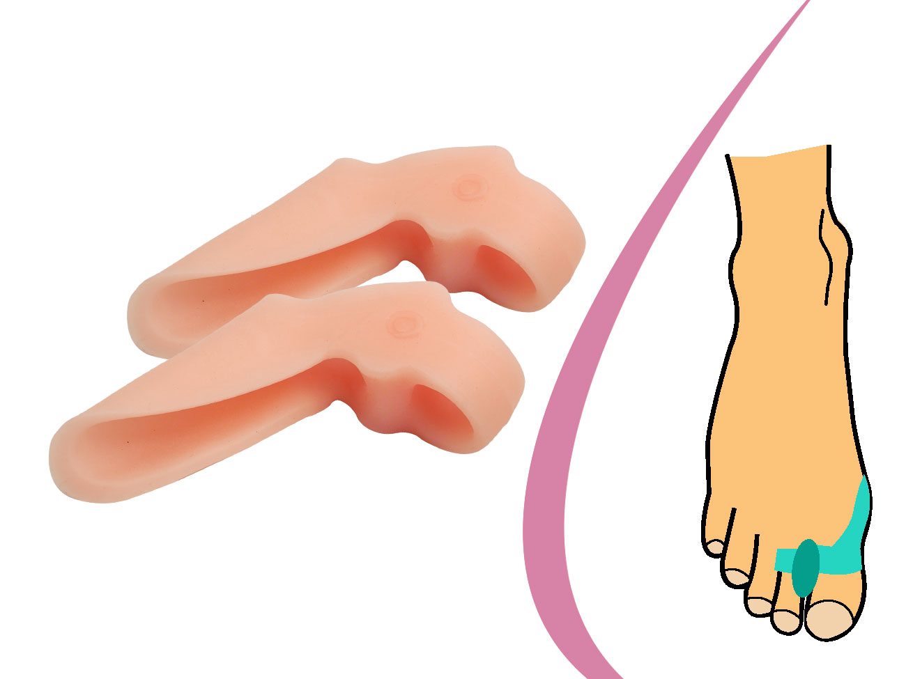 Korektor hallux valgus s návlekom na prst – telový